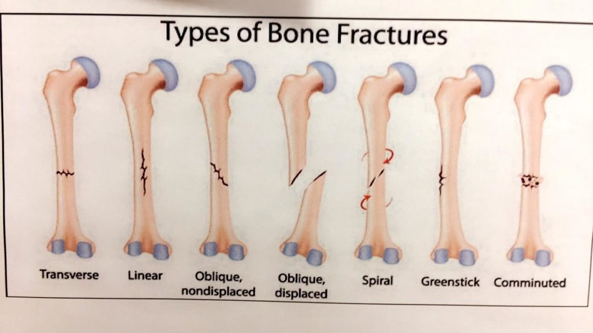 compression bone fracture